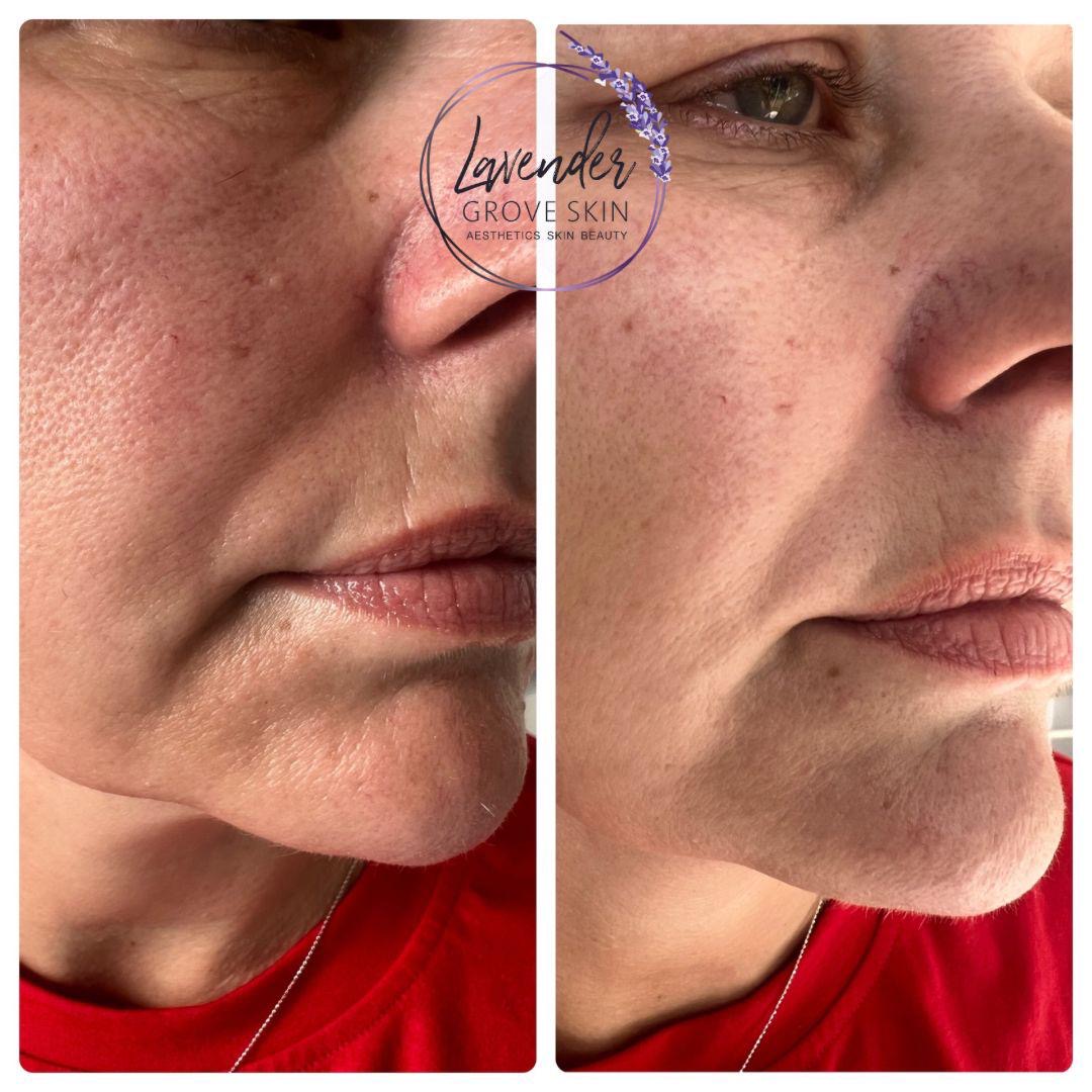 AC 1xtreatment LavenderGroveSkin